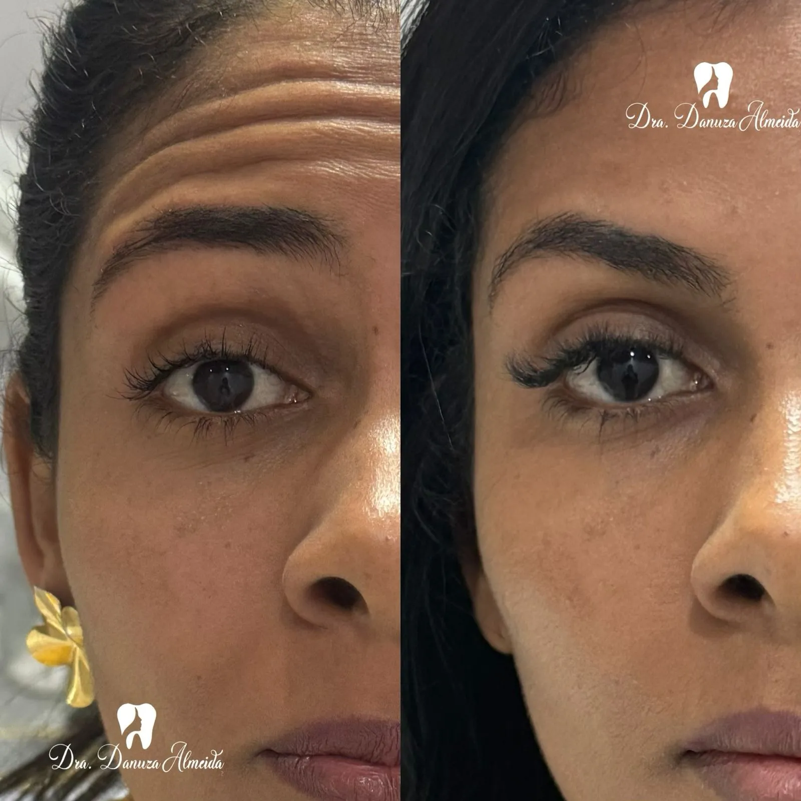 Botox antes — Instituto Dra Danuza Almeida, Petrolina-PE