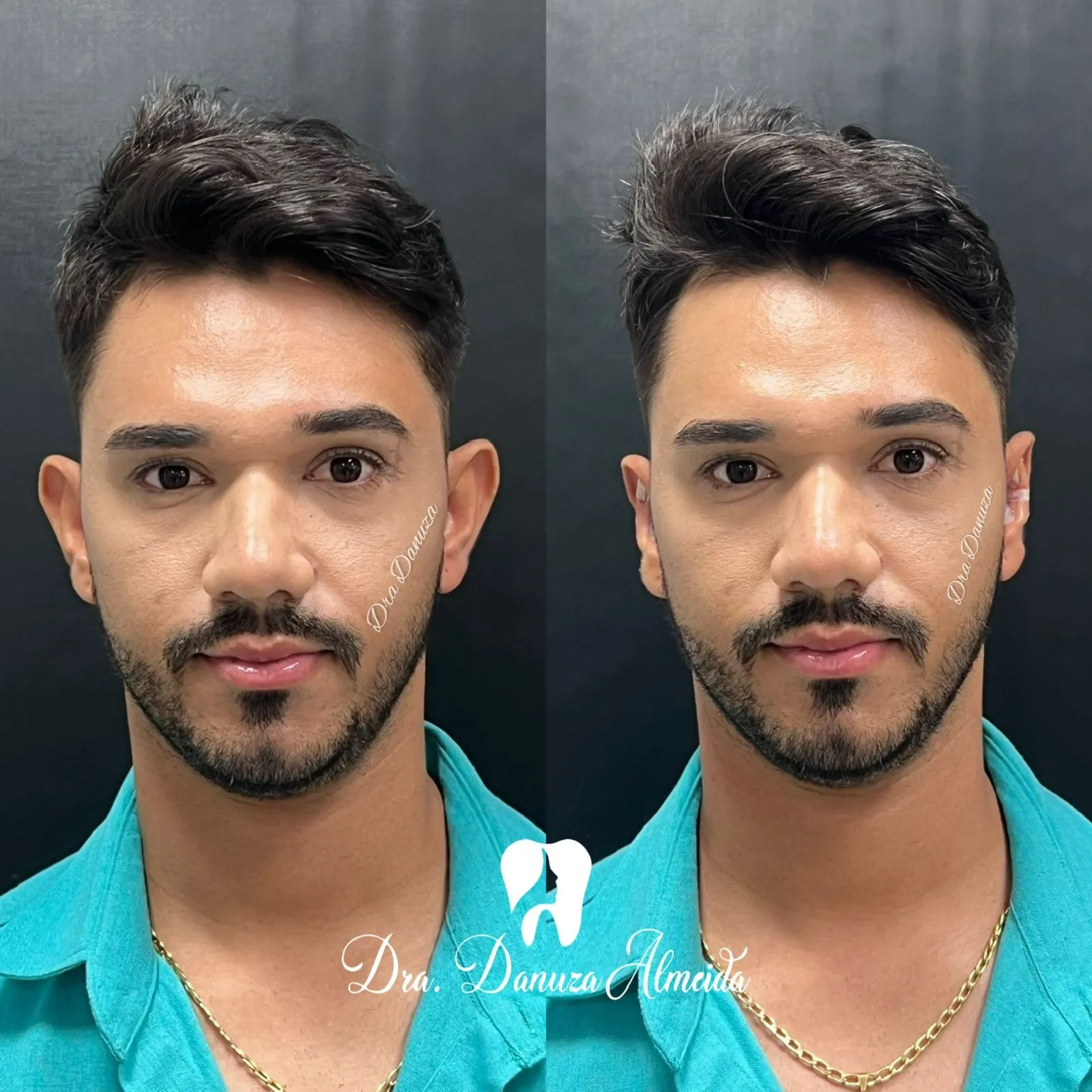 Otomodelação depois — resultado de tratamento estético no Instituto Dra Danuza