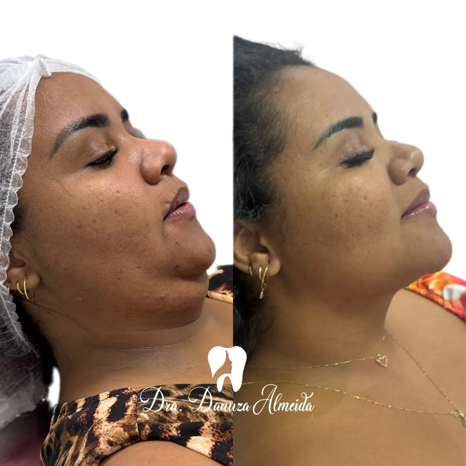 Lipo de Papada antes — Instituto Dra Danuza Almeida, Petrolina-PE