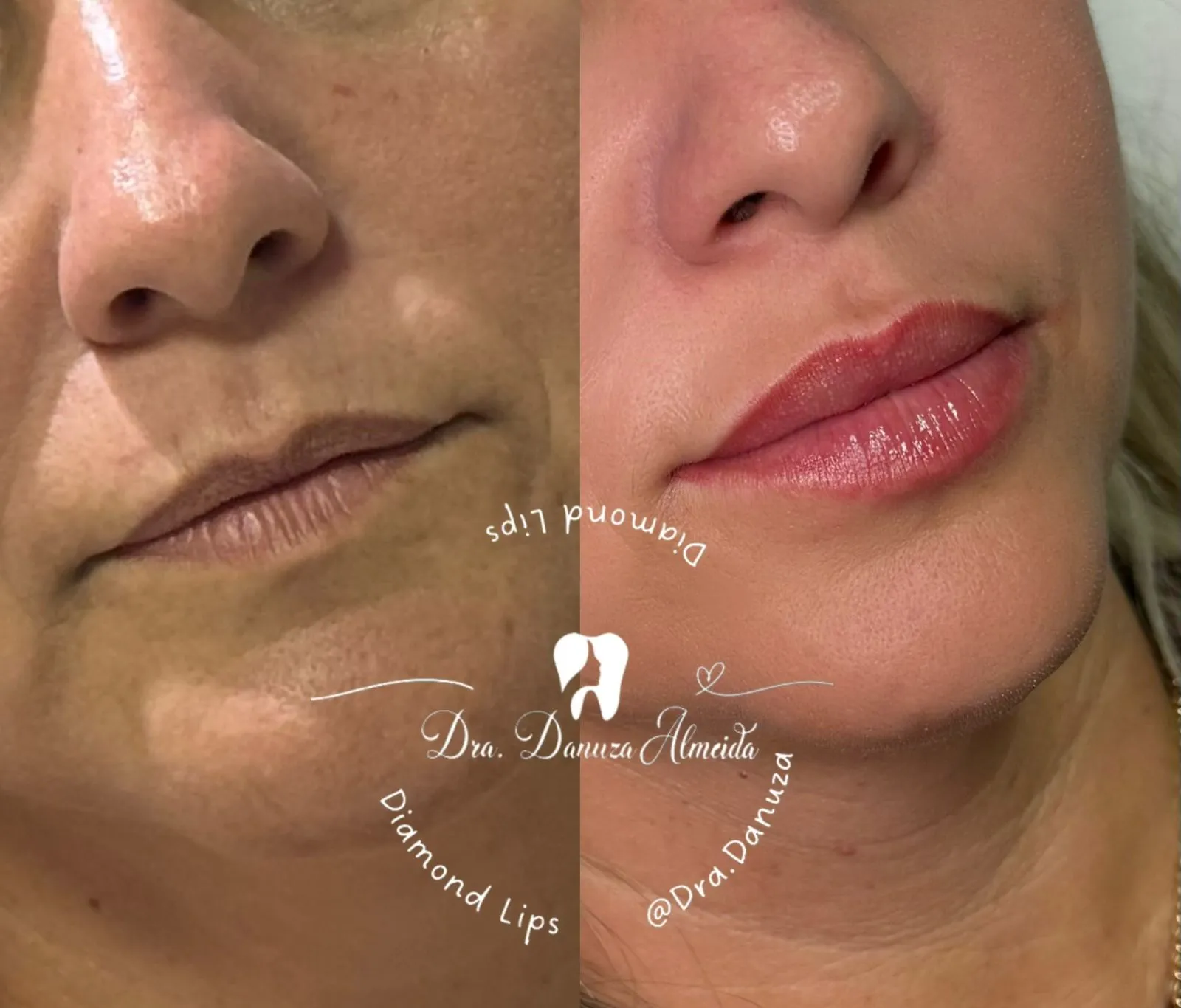 Preenchimento Labial antes — Instituto Dra Danuza Almeida, Petrolina-PE